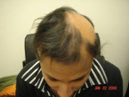 Since the hair entering the degenerative period and the newly entering the growing period is constantly in dynamic balance, the normal amount of hair can be maintained. Acupuncture For Alopecia Hair Loss New York Natural Acupuncture Wellness