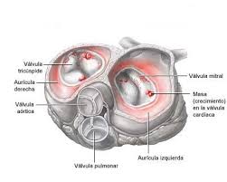 3.4 objetivo de esta guía la guía de práctica clínica: Endocarditis Bacteriana Informacion Medica En Ferato Enciclopedia De La Salud En Espanol