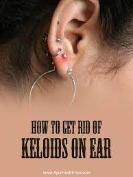 How To Get Rid Of Keloids 9 Home Remedies And Treatments Ayur Health Tips Ear Piercing Care Keloid Piercing Keloid