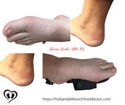 Image result for gout