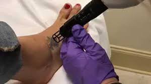 Tattoo removal in jackson, mississippi. Wapt S Keegan Foxx Takes Us Along As She Gets Tattoo Removed