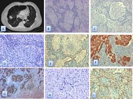 Epithelioid mesothelioma is the most common type and accounts for around 75% of cases. Biphasic Malignant Mesothelioma With Epithelioid And Sarcomatoid Components Dedifferentiated Mesothelioma And Intrapulmonary Growth A Rare Entity Mimicking Desquamative Interstitial Pneumonia Journal Of Clinical Pathology