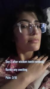 Rose Black Pink Wisdom Teeth