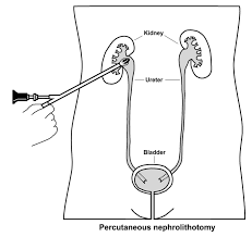 Pdf) Bowel Perforation After Extracorporeal Wave Lithotripsy: A Review Of  The Literature