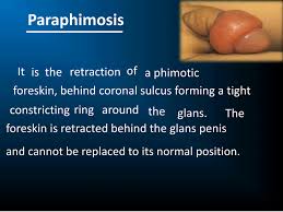 Image result for paraphimosis