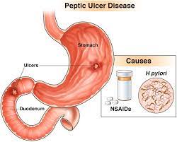 Fat man suffering from stomach pain at night, health problem, ulcer discomfort. Peptic Ulcer Disease Clinical Gastroenterology And Hepatology