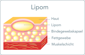 Lipom Ursache Behandlung Entfernung Mooci