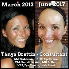 Acne treatment results with lymphatic cream