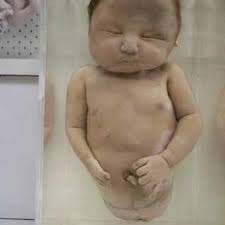 The present controversy over the radiological and chemical toxicity of depleted uranium used in the gulf war warrants further experimental and clinical investigations of its effects on the biosphere and human organisms (durakovic, 1999). Pdf Depleted Uranium