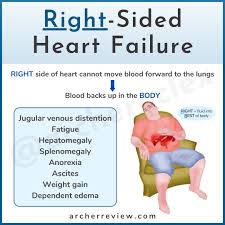 Image result for Right Heart Failure