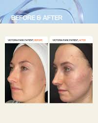 LAST CHANCE! Promo ending today.‼️ Microneedling is a great summer  treatment option to refresh your skin, reverse sun damage, and refine  pores. Unlike some facial rejuvenation procedures that use heat, light or