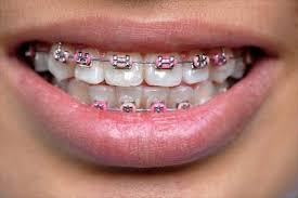 Asian Teens Shell Out Money For Fake Fashion Braces Pink Braces Braces Colors Cute Braces Colors