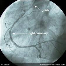 Видео nea rică, stent la. Coronarografie Cu Sau Fara Implantare Stent Indicatii Riscuri Pret Video Cabinet Cardiologie Deva Dr Benteu Darius