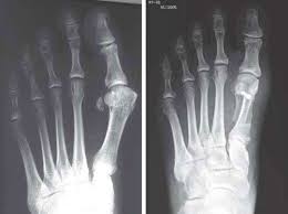 We did not find results for: Hallux Valgus Indikation Und Therapie