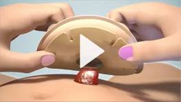 The first few times you change your colostomy pouch it will likely feel challenging. How To Change A Stoma Bag Correctly Salts Healthcare