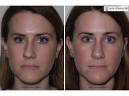 Maybe you would like to learn more about one of these? Septoplasty And Rhinoplasty For Sinus Symptoms