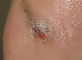 Since not all bccs have the same appearance, these images serve as a general reference to … Can Skin Cancer Look Like A Blood Blister