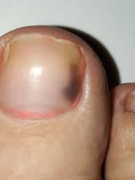 Most cases of subungual melanoma occur in the thumbnail or big toenail. Pictures Of Skin Cancer On Toenails