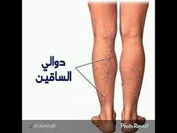 تم علاج دوالي الساقين بالحجامة youtube