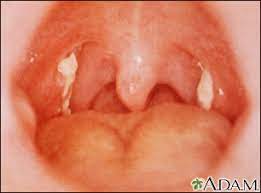 Aug 13, 2019 · mono (mononucleosis) is also called infectious mononucleosis. Mononucleosis Information Mount Sinai New York