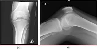 Ask questions and get answers about knee joint replacement. Unlocking A Locked Knee By Ultrasound Guided Anesthetic Injection Sciencedirect