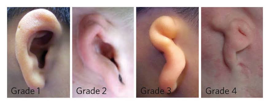 What are Microtia and Atresia? – The Microtia and Atresia Clinic at  Vanderbilt