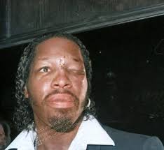 Heavyweight Mitch "Blood" Green sports facial damage from a street brawl  with Mike Tyson while speaking to reporters after the incident in 1988.  Tyson and Green fought in the ring in 1986,