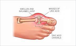 5 natural ingredients · 30 day trials available What Is Gout Anrf
