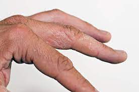 Neurodermitis an den händen neurodermitis kann verschiedene teile des körpers betreffen. Neurodermitis Ratselhafte Krankheit Pz Pharmazeutische Zeitung