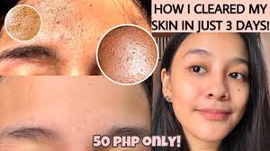 Levels of exfoliation · dermatologist tested · plastic microbead free How To Get Rid Of Tiny Bumps On Forehead Face Fast Fungal Acne How I Cleared My Skin Eng Sub Youtube