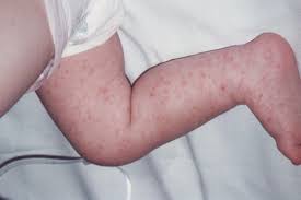 Sympthom bintik merah di badan. Bintik Merah Pada Kulit Bayi Yang Umum Dan Harus Diwaspadai