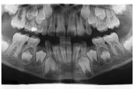 Es gibt unterschiedlich große zähne und formen. Gebissaufbau
