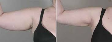 Arm Liposuction Without Surgery 3 Liposuction Before And After