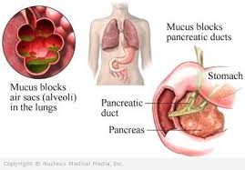 Cystic fibrosis of the pancreas and its relation to celiac disease. Mukoviszidose Beschreibung Diagnose Behandlung Krankheit Zustand Verletzungen