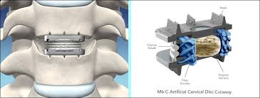 Ein cervicales facettensyndrom ist ein facettensyndrom im bereich der halswirbelsäule (hws). Bandscheibenvorfall An Der Halswirbelsaule Neurochirurg Darmstadt