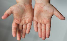 Image result for vyrážka u dětí