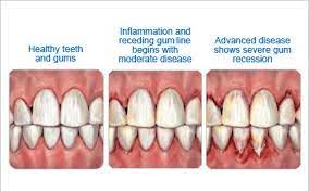 Perio Org Gum Disease Treatment Gum Disease Periodontitis