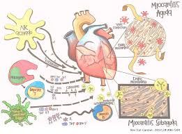 Conocer los principales abordajes diagnosticos. Miocarditis En Pediatria Revista Colombiana De Cardiologia