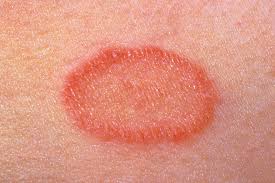 This is then followed, days to weeks later, by a rash of many similar but smaller round or oval lesions, mainly on the trunk and upper limbs. Pityriasis Rosea Healthdirect