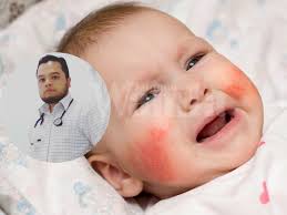 Sesetengah perkara mungkin perlu dielakkan jika bayi anda. Doktor Ini Kongsi Rawatan Asas Penyakit Eczema Yang Mak Ayah Boleh Kawal Patut Ambil Tahu Mingguan Wanita