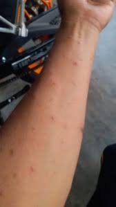 ^ chicken pox parties do more harm than good, says doctor. Chicken Pox Cacar Air Omma Yad