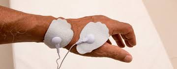 Image result for Electrical Stimulation Therapy
