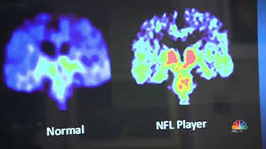 The left side of the brain is more involved with attention to the internal world. Cte Study Finds Evidence Of Brain Disease In 110 Out Of 111 Former Nfl Players