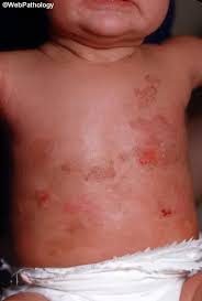 Image result for Urticaria pigmentosa children