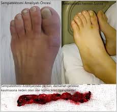 Prof Dr Ahmet Akgul Burger Buerger Damar Tikanma Hastaligi