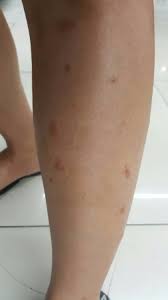 Mild forms of the condition can heal causes: Marsas Namelis Nubausti Spots On Legs Yenanchen Com
