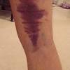 Most hamstring injuries occur in the biceps femoris, which is the most lateral of the hamstrings, situated towards the outside of the thigh. Https Encrypted Tbn0 Gstatic Com Images Q Tbn And9gcs5zbj6edkflbsaydz6n Qmr Ub8zmy0yd7eb5v7zdv34 F5mro Usqp Cau