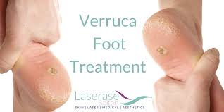 This kind of fungus thrives in moist, warm environments. Verruca Treatment At Laserase News Laserase Bolton