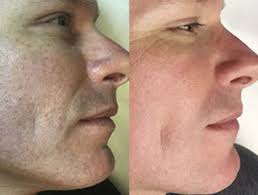 Top 5 laser hair removal devices for men. Facial Hair Removal Dermatology Associates Of Seattle