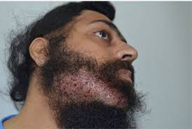 Facial hair transplantation replaces hair on areas of the face that are either missing hair or are very sparse in density. Beard Transplant In India Facial Hair Transplant And Cost